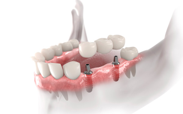Implantes_Dentales_Castellon_Clinicas_Cabrera_Implantes_Seguros