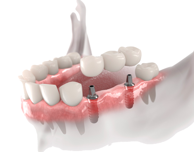 Implantes dentales inmediatos