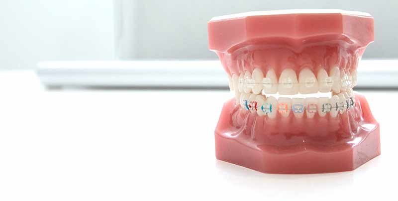 Analisis_Oclusal_Ortodoncia_Invisible_dentista_Castellon_Implantes_Cabrera