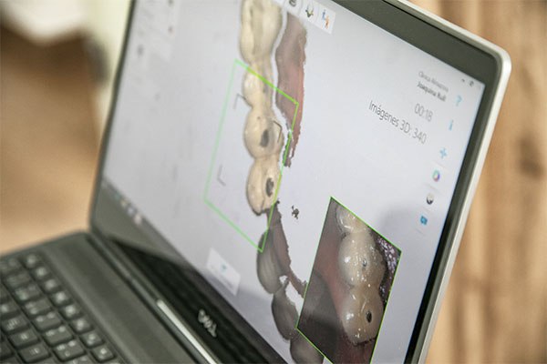 Proceso del escáner intraoral en 3D. Servicio odontología