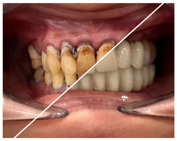 Implantes-dentales-jovenes-castellon