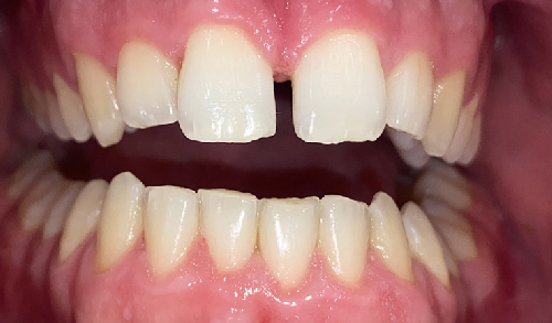 Antes-y-despues-ortodoncia-8a