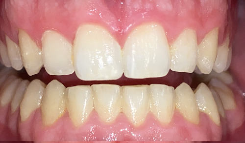 Antes-y-despues-ortodoncia-8b