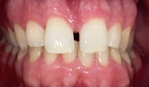 Antes-y-despues-ortodoncia-8c