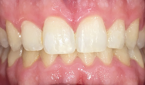 Antes-y-despues-ortodoncia-8d