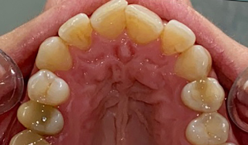 Ortodoncia-con-alineadores-7e