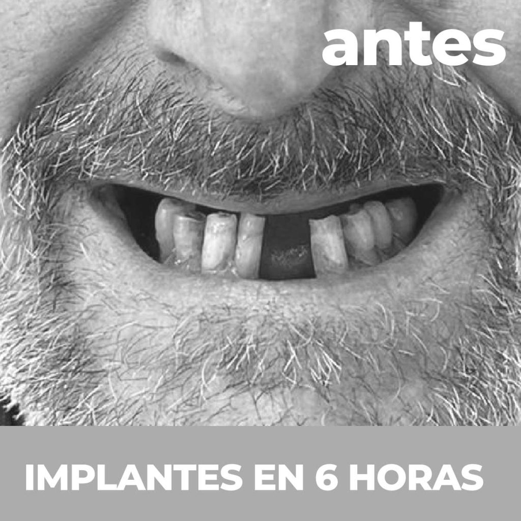Una boca antes de implantes dentalesde Clínicas Cabrera en Burriana