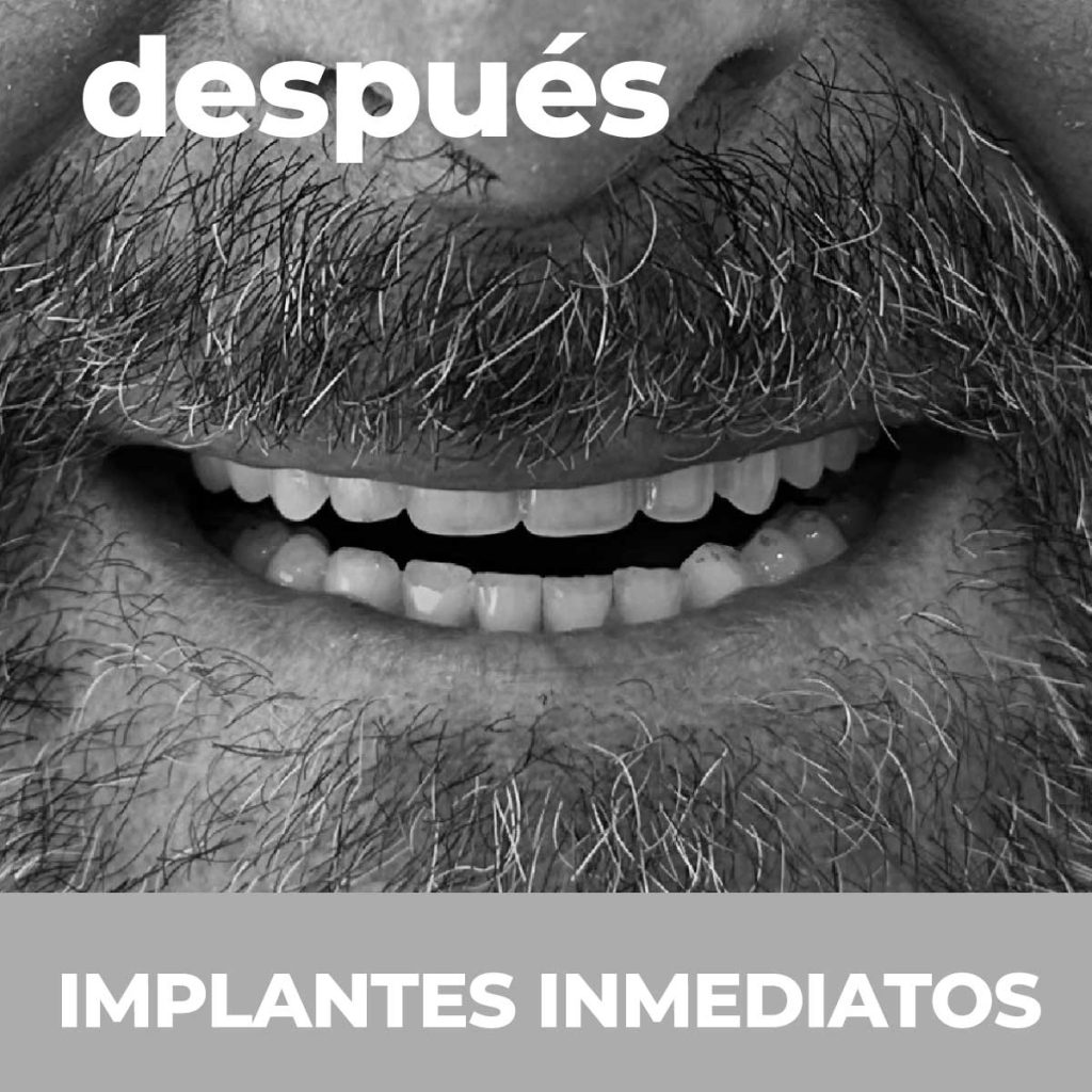 Una boca con implantes de Clínicas Cabrera en Burriana 