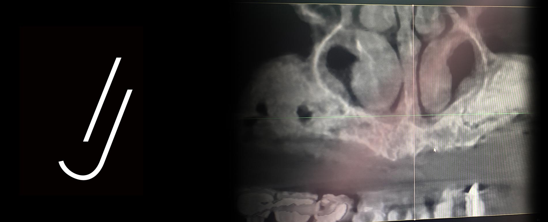 Implantes-dentales-sin-hueso-Cabrera